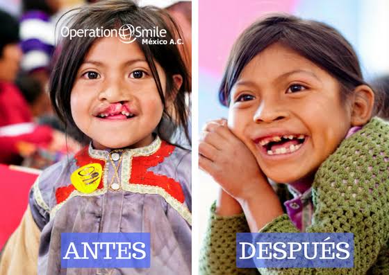 Operación Smile México, el Consorcio Mexicano de Hospitales y la Asociación Mexicana de Cirugía Plástica, se unen para operar a pacientes con Paladar Hendido